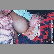 breast51